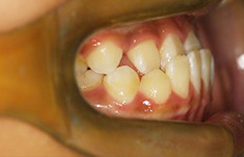 treatment_img_23
